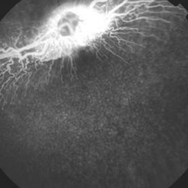 Rabbit fundus angiogram, saline, no CNV