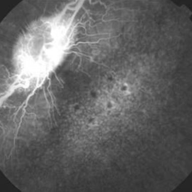 Rabbit fundus angiogram, CNV with Eylea