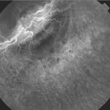 Rabbit fundus angiogram, CNV with DWRX2008 drops