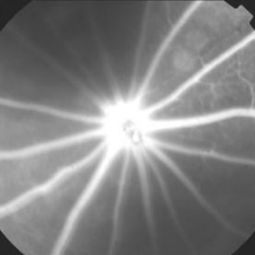 Fundus angiogram, diabetic rat with vehicle