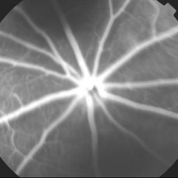 Fundus angiogram, diabetic rat with Lucentis