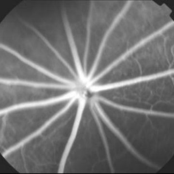 Fundus angiogram, diabetic rat with DWRX2008 drops
