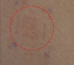 Skin at the patch site after 4 hours of wear